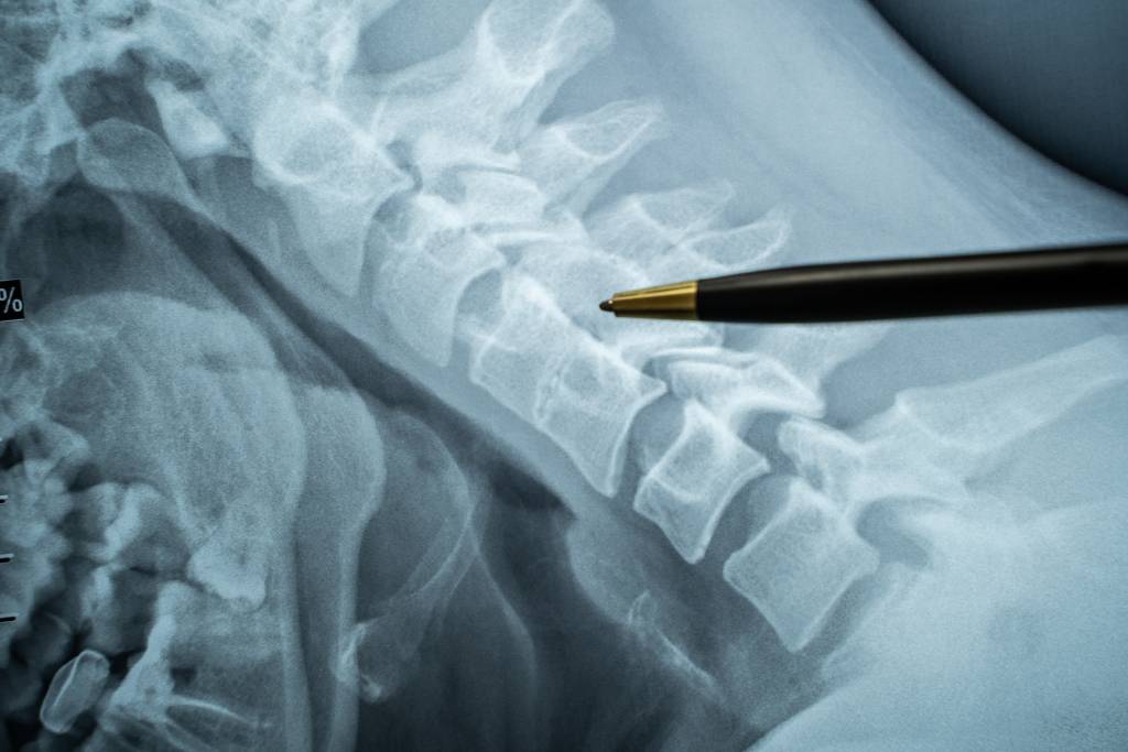 Cost to Treat a Spinal Cord Injury