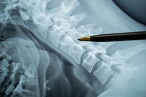 Cost to Treat a Spinal Cord Injury