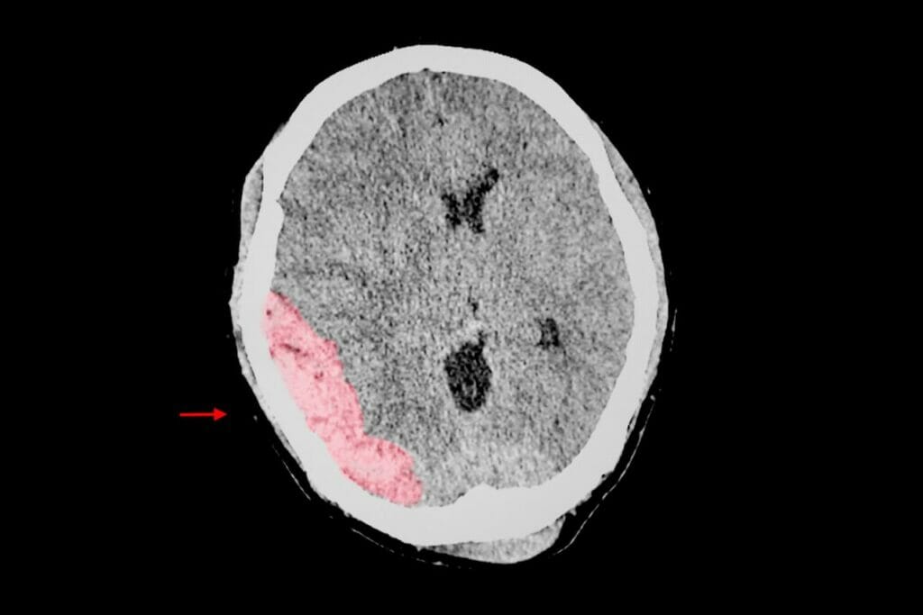 chicago brain injury attorney