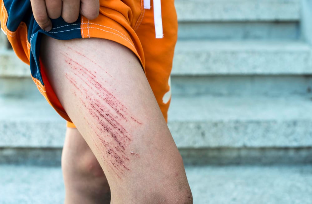 What is a Degloving Injury?