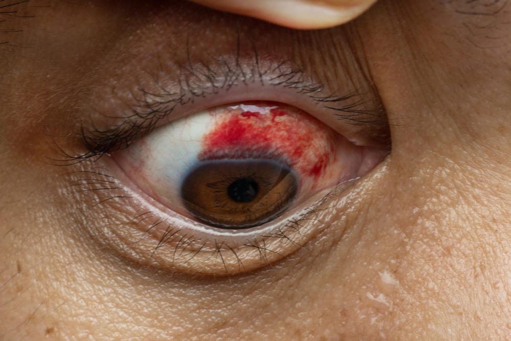 Infant Subconjunctival Hemorrhage Birth Injuries