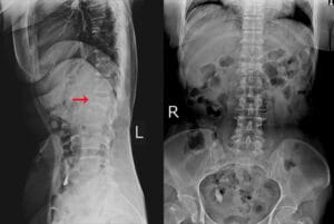 Sacral Spine Injury