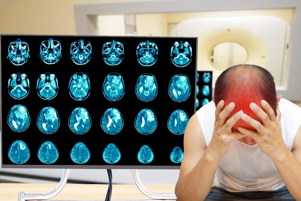 Showing the brain with areas of encephalomalacia highlighted, indicating softening of brain tissue due to head trauma.