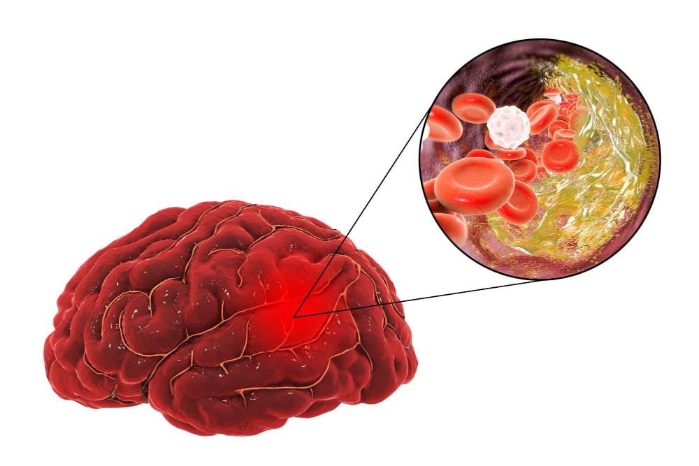 Rare Encephalitis Commonly Misdiagnosed as Mental Illness