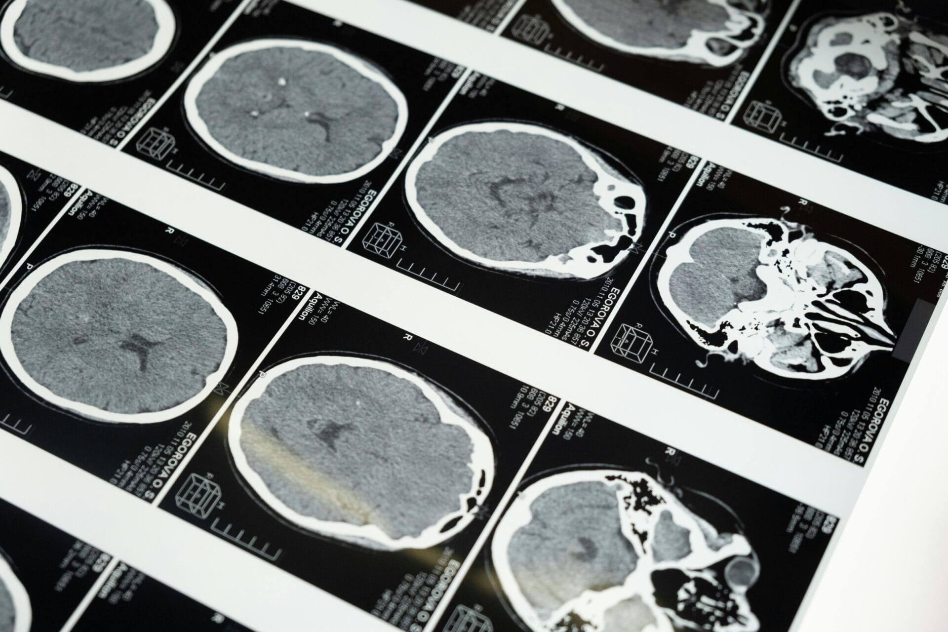 Detailed brain MRI scans displayed on lightbox for diagnosing undiagnosed childhood brain injuries